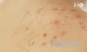 出血点和紫癜区别图片(如何判断是不是紫癜)